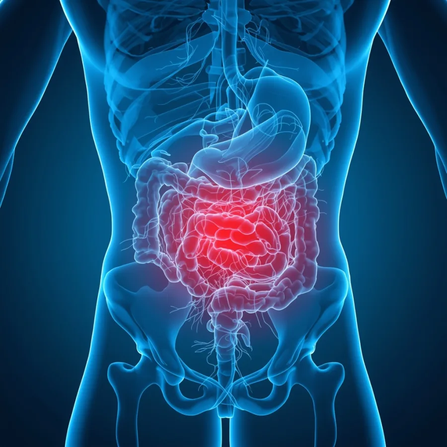 ¿Qué médico trata la diverticulitis en CDMX?